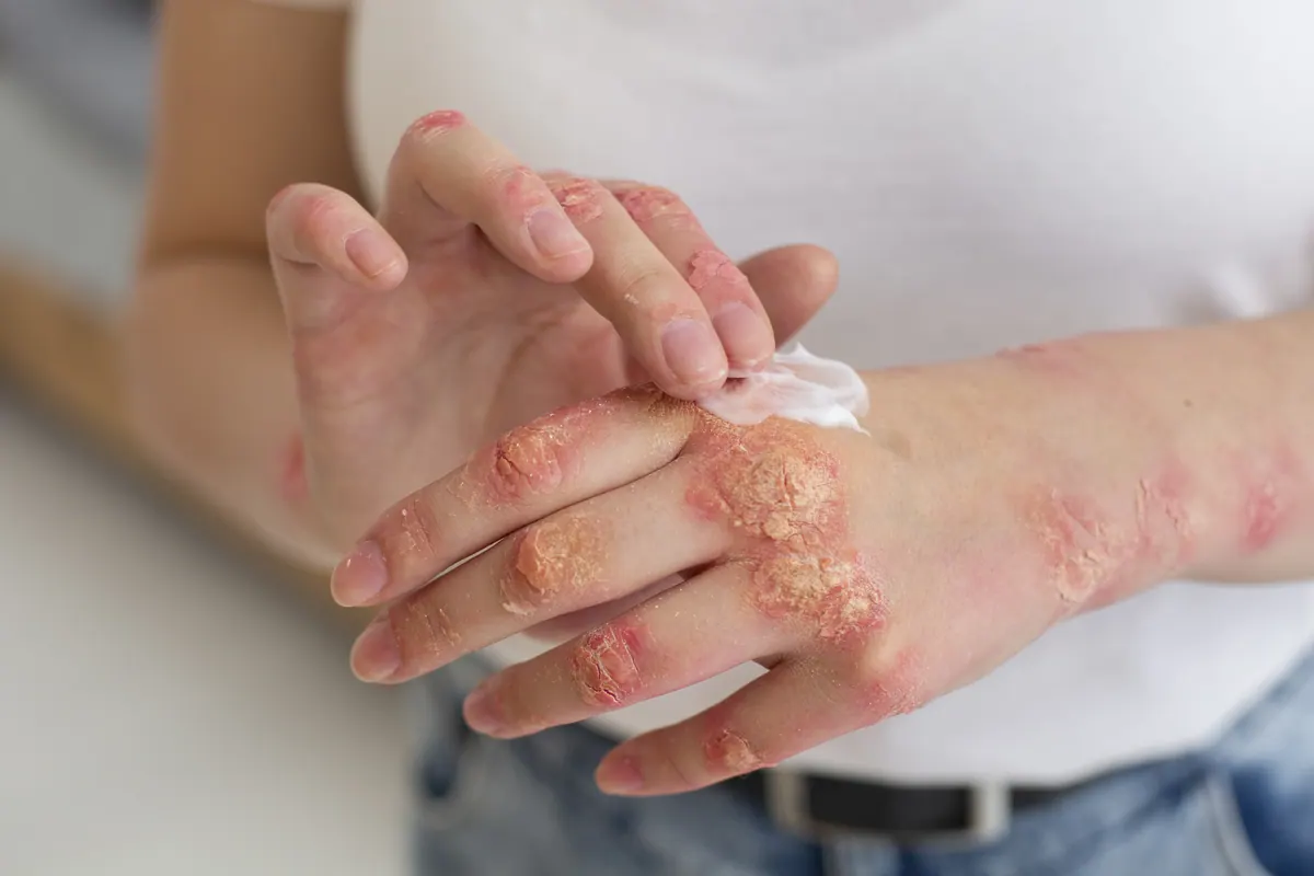 Soin de la peau avec une crème émolliente