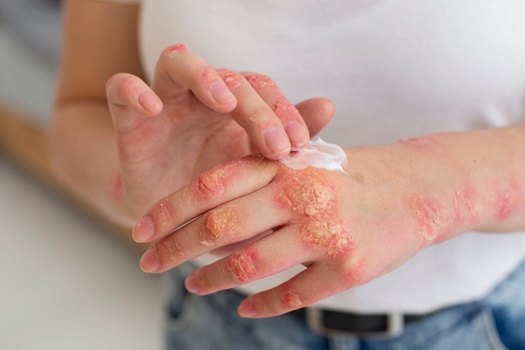 Psoriasis
